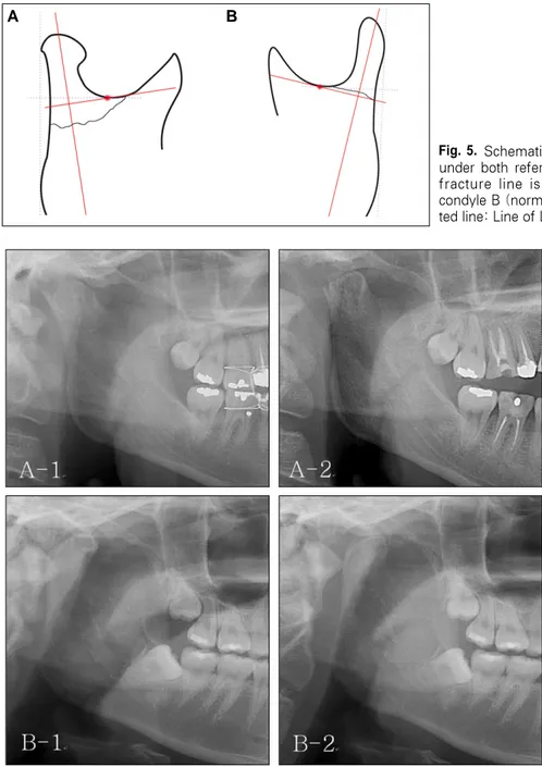 Fig. 6. Condyle resorption on cases of closed  reduction.  Proximal  condylar fragments were deviated  antero-infe-rior  direction  A-1  and  anteantero-infe-rior   direc-tion B-1 after injury