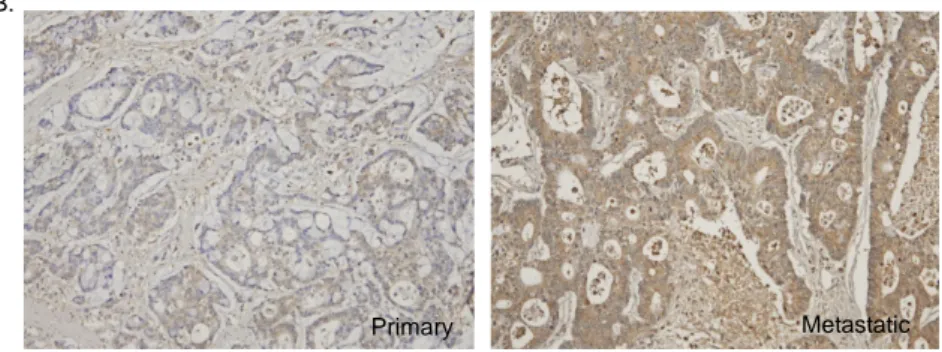 Figure 1. Osteopontin expression in primary and metastatic colorectal  carcinomas (x 100)