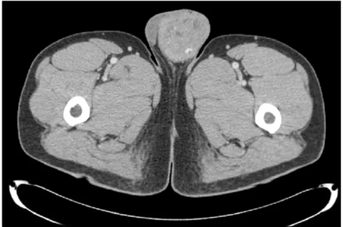 Fig.  1.  The  abdominal  computed  tomography  (CT)  scan  reveals  a  about  6.7x6.5cm    sized,  heterogenous  mass  on  left  side  spermatic  cord.