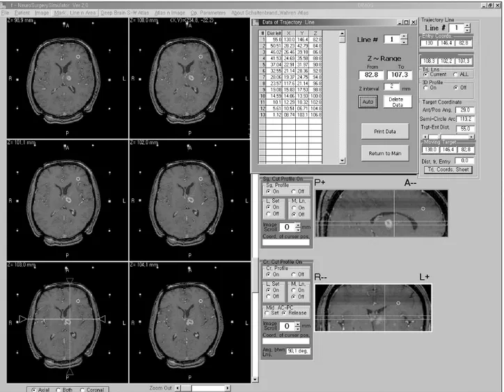 Fig. 1. Planning for stereotactic biopsy using K-Neuroplan ® . 