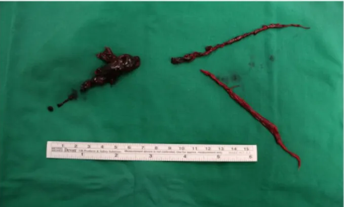 Fig. 3. 30×50 mm sized left side thrombi is from right main 
