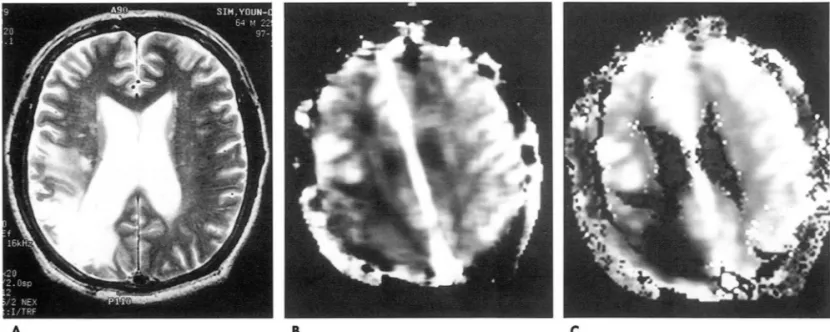 Fig.  4.  rCBV  and  relative  perfusion  rate  maps  of  a  patient  with  cerebral  infarct  on  the  right  parietallobe
