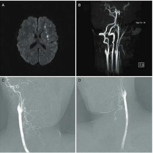 Figure 1. Brain MRI and angiographic findings of the patient. Diffusion-weighted image (A) 