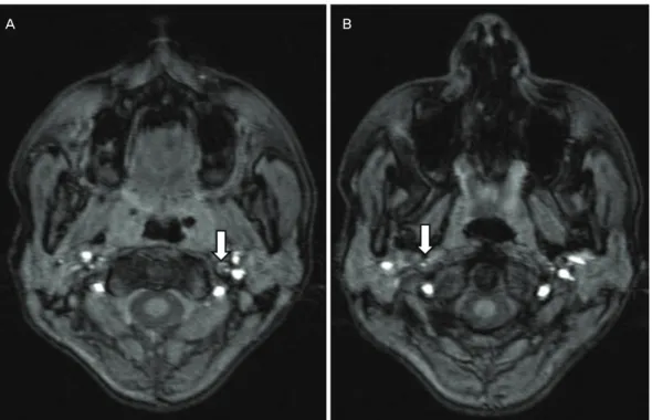 Figure 2. Brain MR angiographic source image of the patient (A, B). White arrows indicate a narrow lumen 