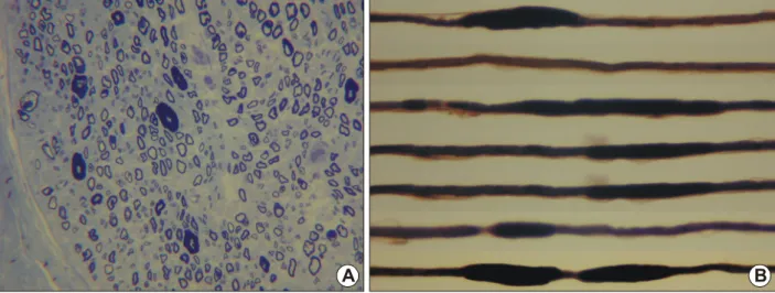 Figure 4. Transverse semithin section of sural nerve. Thickening of myelin sheath (tomacula) are occasionally seen (A, Toluidine blue, ×400).