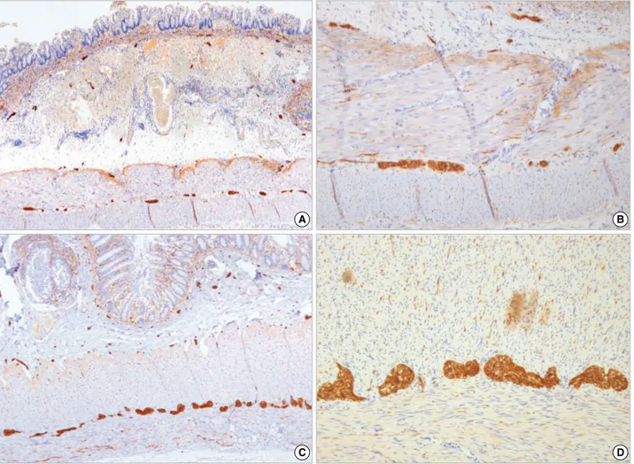 Fig. 1. Hypoganglionosis of myenteric plexus. Lower and high magnification (A, B) of a hypoganglionosis case (3.25 nerve cells/mm) shows a markedly decreased number and size of myenteric ganglia (at nine days after birth, gestational age [GA] 31.4 wk) comp
