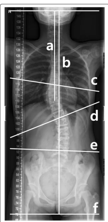 Fig. 2 Radiographic measurements. The scoliosis Cobb angle was measured between c and d