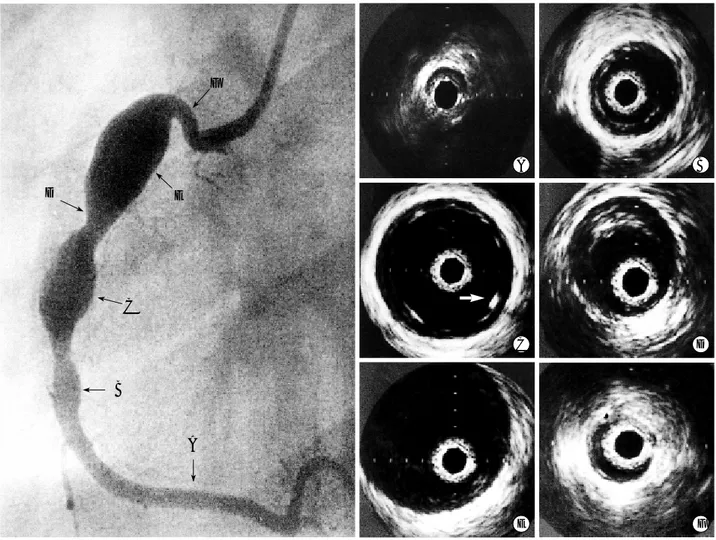 Fig. 1. A coronary angiogram and intravascular ultrasound (IVUS) images from the right coronary artery