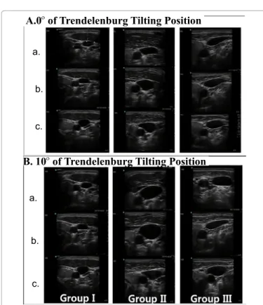 Figure 3: Ultrasound images of relative positions of the right internal jugular 