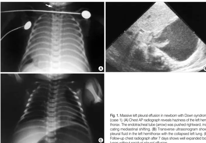 Fig. 1.  Massive left pleural effusion in newborn with Down syndrome (case 1). ( A ) Chest AP radiograph reveals haziness of the left  hemi-thorax