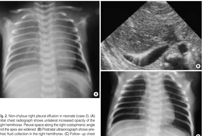 Fig. 2.  Non-chylous right pleural effusion in neonate (case 2). ( A ) Initial chest radiograph shows unilateral increased opacity of the right hemithorax