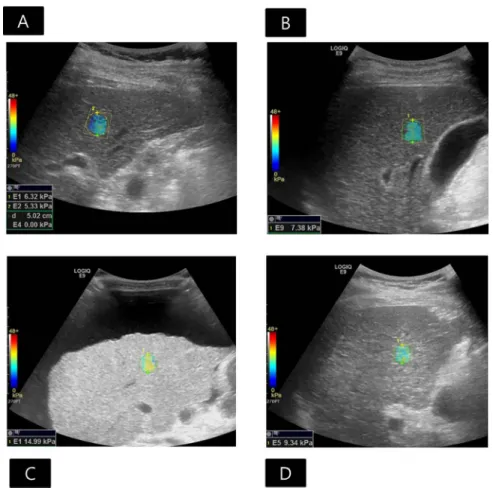 Fig 5. When applying the cutoff values from our study, the live stiffness (LS) values obtained by the 2D comb-push shear wave elastography (2D CP-SWE) could predict histologic fibrosis staging