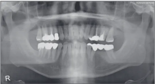Figure 1 Rotational panoramic tomography shows bilateral symmetry of the maxillary first molars with a blunt root apex and a radiolucent lesion.International Journal of Oral Science (2013) 5, 242–244