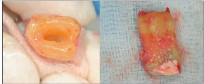 Figure 5 The apical 3 mm of the root were trimmed and on the prepared apical O-shaped root surface there were 5–6 root canals with connecting fins and they were checked by methylene blue