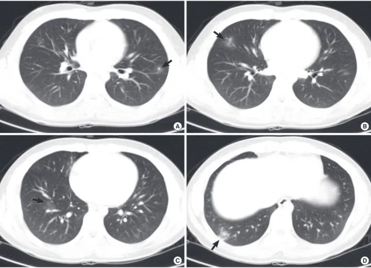 Fig. 1. Computed tomography (CT) scan findings of the chest. Multiple nodules with ground glass opacity halo in the left upper lung field (A) and ill defined patches of nodular  ground glass opacity are shown in the right middle (B) and the right lower lun