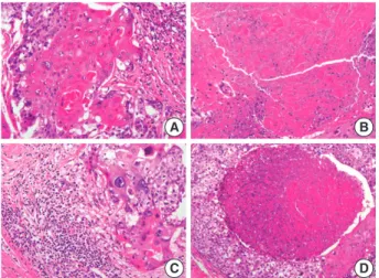 Fig. 1. Metaplastic squamous carcinoma shows keratin pearl for- for-mation in the tumor (A), necrosis (B), severe neutrophilic and  lym-phocytic infiltration in the tumor (C), and squamous cell carcinoma in situ with comedo-necrosis (D).
