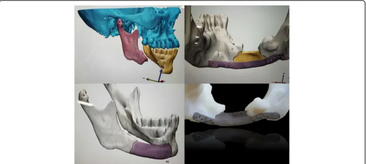 Fig. 1 Pre-operative diagnosis, virtual surgery, and creation of patient-specific implants using CAD/CAM software