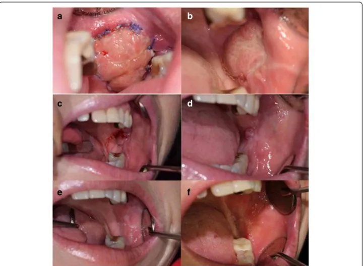 Fig. 3 Re-epithelialization of the grafted buccal fat pad after operation. a. The ninth day