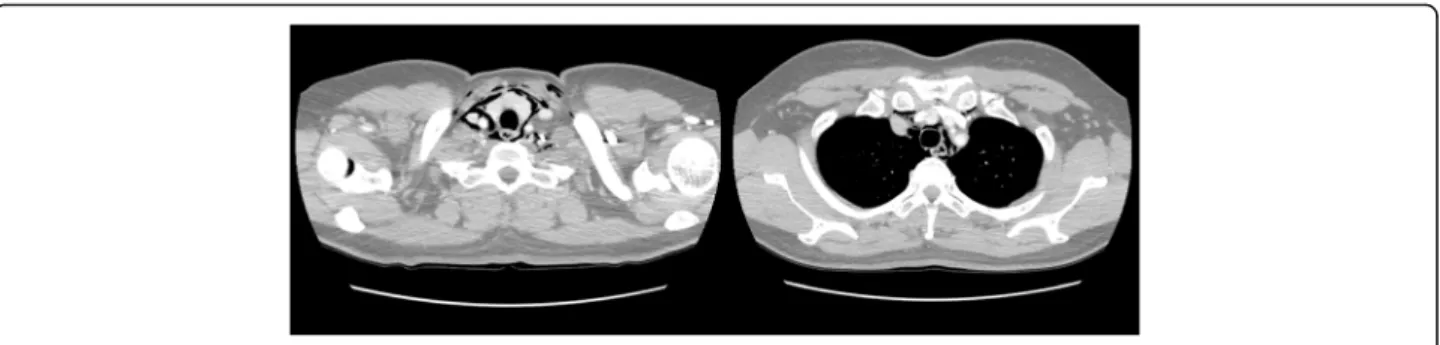 Fig. 4 Chest computed tomography revealing emphysema extending to the mediastinum