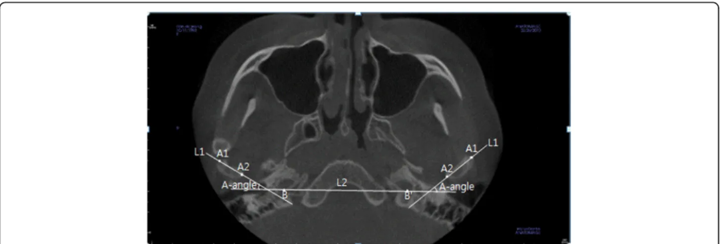 Fig. 1 Reference points and measurement of axial view in CBCT. A1 outer pole of condylar head, A2 inner pole of condylar head, B,B ′ hindmost point of the carotid canal, L1 line passing A1 and A2, L2 line passing B and B ′, A-angle angle between L1 and L2
