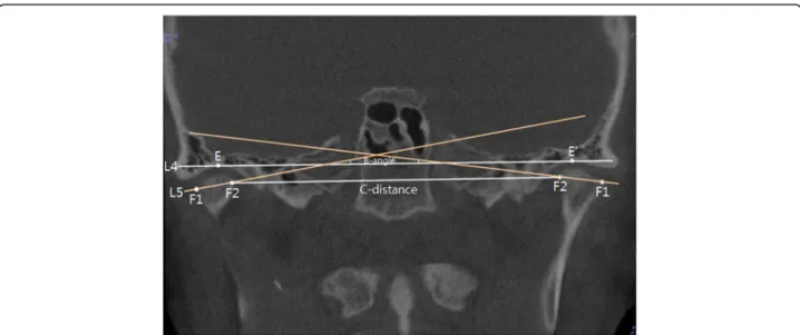 Fig. 3 Reference points and measurement of coronal view in CBCT. E,E ′ highest point with joint, F1 outer pole of condylar head, F2 inner pole of condylar head, L4 line passing E and E ′, L5 line passing F1 and F2, B-angle angle between L4 and L5, C-distan