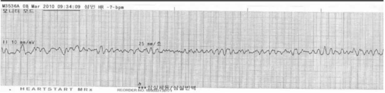 Figure 1. Rhythm was a patient's initial VF (ventricular fibrillation) rhythm that was seen with monitor mode of automated external defibrillator.