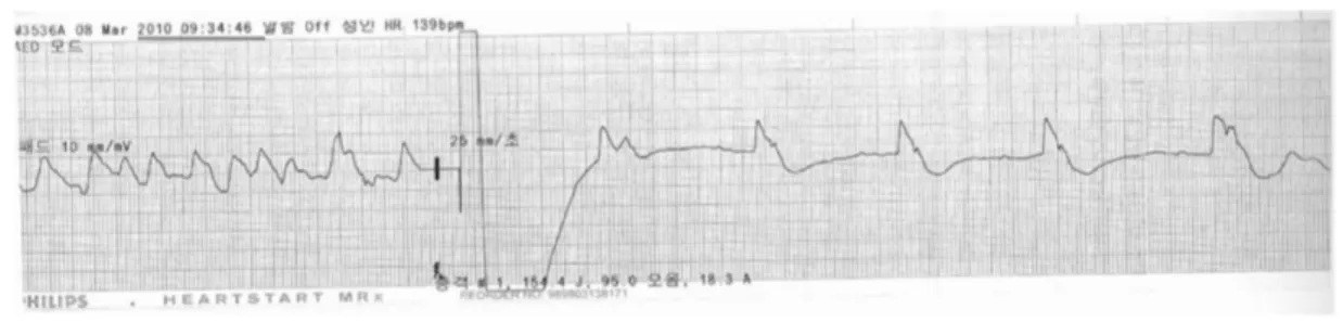 Figure 3. VF (ventricular fibrillation) rhythm that has continued after the second electric shock.