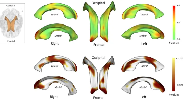 Figure 2. Locations of shape differences in the lateral ventricles, uncorrected for multiple comparisons
