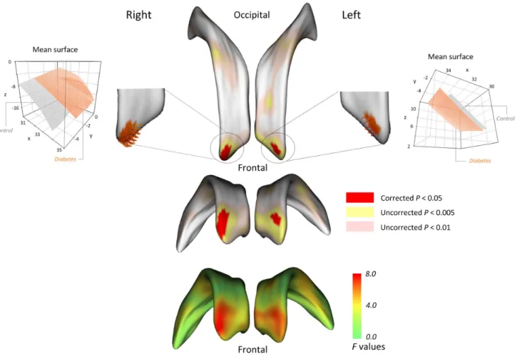Figure 3. Locations of shape differences in the lateral ventricles, corrected for multiple comparisons