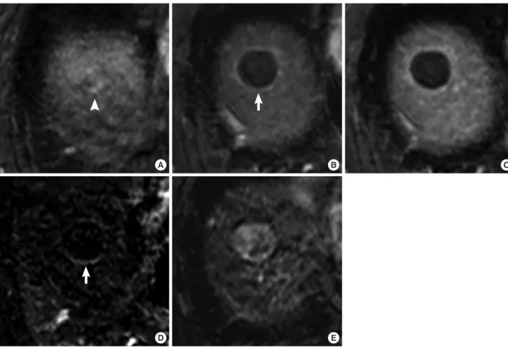Fig. 1. A 61-yr-old man treated with DEB-TACE for HCC. (A) An arterial enhancing mass (white arrowhead) is noted on the MRI obtained before DEB-TACE