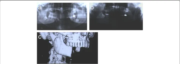 Fig. 1 a Orthopantomogram before treatment. b Orthopantomogram and c 3-D computed tomography scan after segmental mandibular resection
