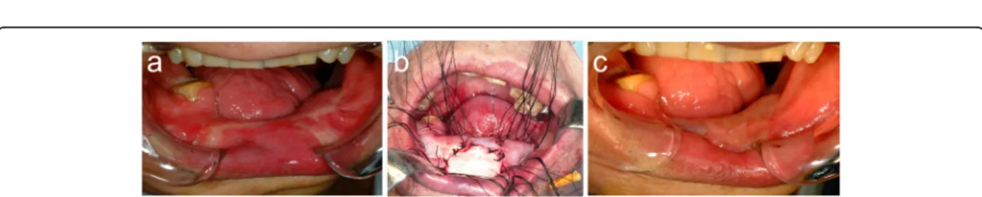 Fig. 4 a, b Two distractors were fixed at the planned position. Orthopantomogram c 1 day postoperatively and d at the end of distraction osteogenesis