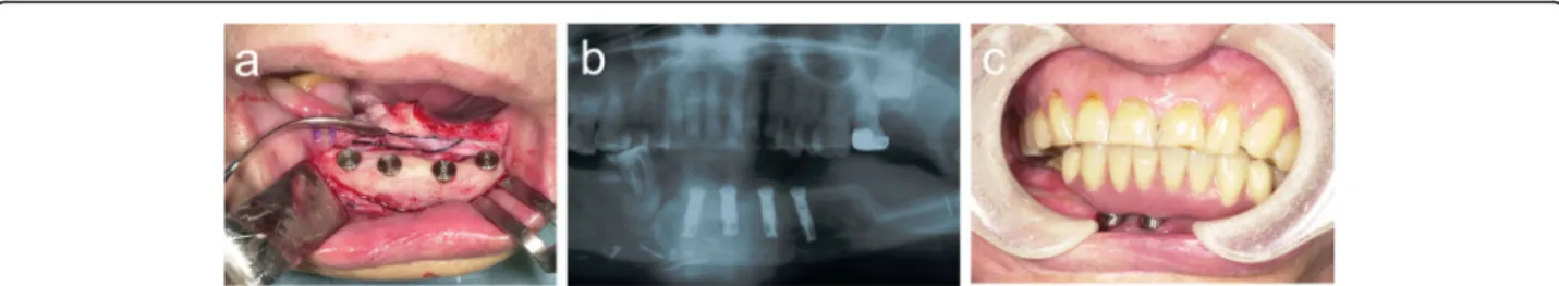 Fig. 7 a Four dental implants were inserted into the distracted fibula. b Orthopantomogram after implantation