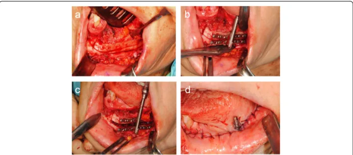 Fig. 10 a Sagittal osteotomy was performed on the vestibular aspect of the fibula. b The distractor was fixed at the planned position