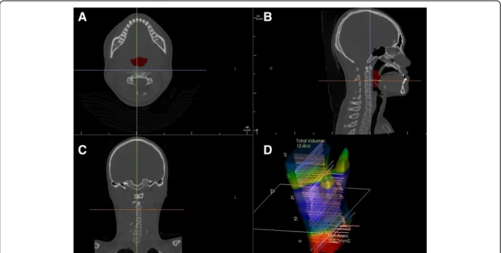 Fig. 1 DICOM file is reconstructed into four basic views. a Horizontal view: In this plane, the area, maximum lateral width and maximum anteroposterior width of the airway parameters were measured