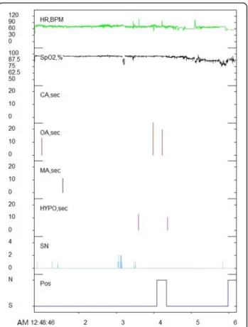 Fig. 4 Analysis of polysomnography. While the patient was sleeping, heart rate, beats per minute, SpO 2 , central apnea, obstructive apnea, mixed apnea, hypopnea, snoring, and sleep posture were recorded