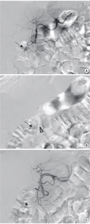 Fig. 4. Angiographic findings of case 2. (A) Celiac artery angiogram shows no definite  extravasation, but a focal nodular hypervascular staining (arrow) in the second  por-tion of the duodenum suggesting hypervascular tumor staining
