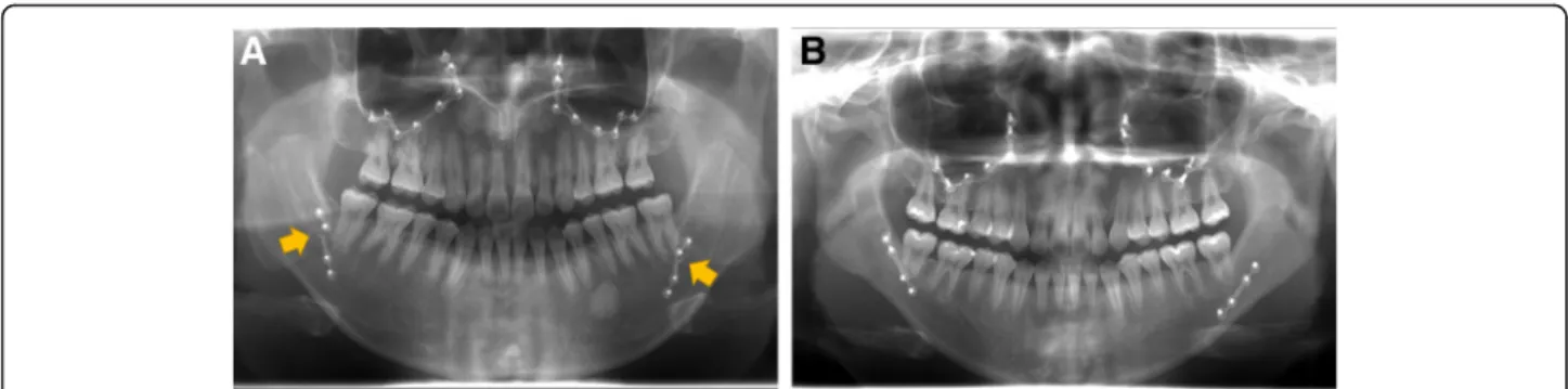 Fig. 1 Panoramic view at 6 months after operation. a No treatment group showed plate fracture in both sides (arrows)