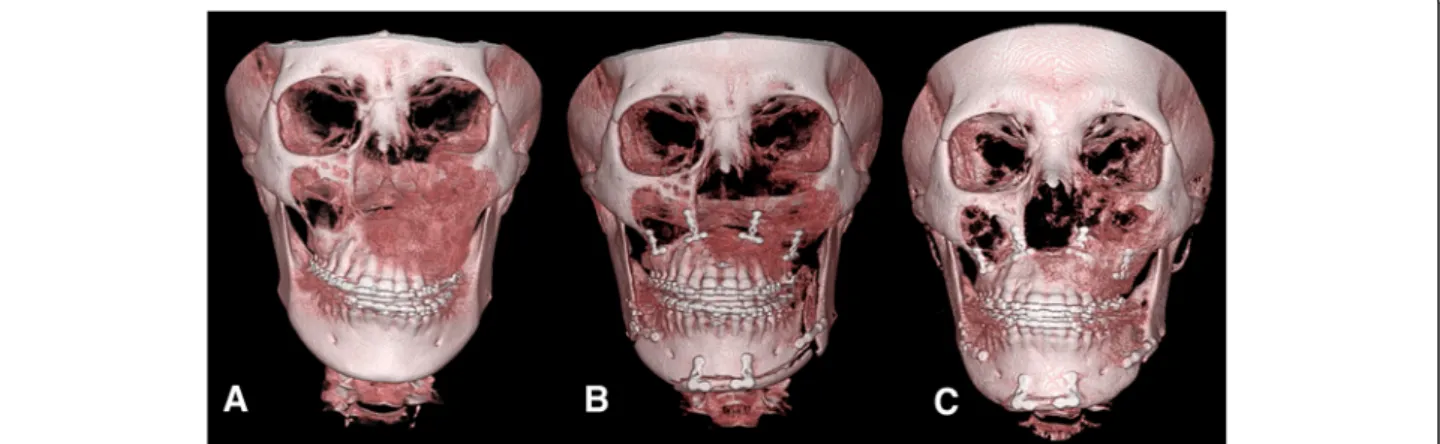 Fig. 1 3D CT image of patient no. 1 preoperative (a) immediately postoperative (b) and 1 year postoperative status (c) showing improvement in occlusal canting following Le Fort I and wing osteotomy on the mandibular body and chin with rigid fixation