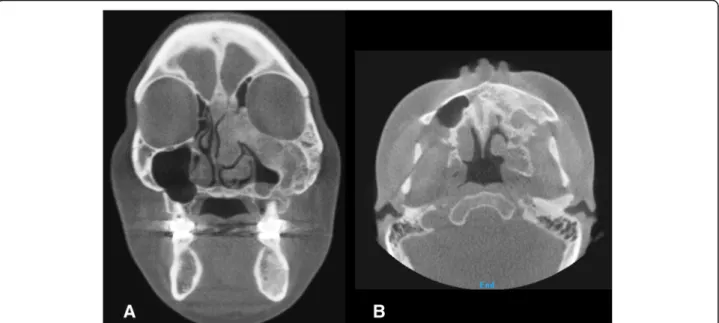 Fig. 5 3D CT image of coronal (a) and axial (b) view 4 years postoperative. No further expansion or re-growth of the dysplastic lesion was noted