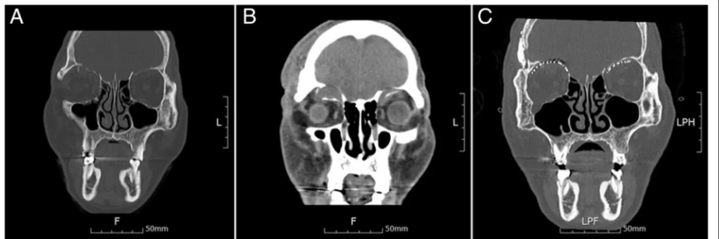 Fig. 1 a The displacement of the fracture fragment does not appear severe on computed tomographic (CT) images taken immediately after the injury
