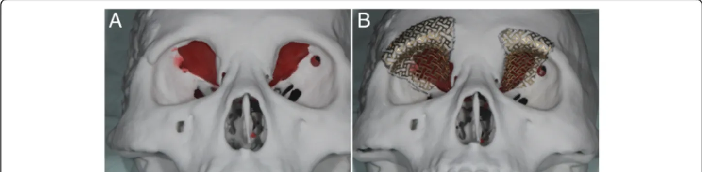 Fig. 3 a The orbital wall defect was restored using a plate wax. b Contouring of the titanium mesh was done using a customized skull model