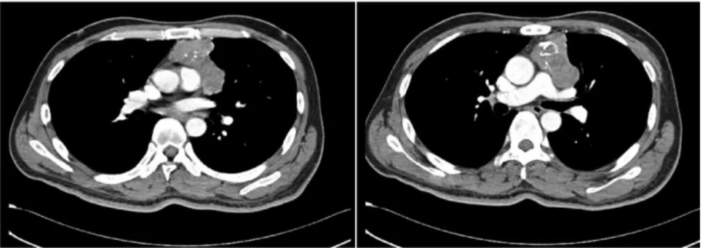 FIGURE 3. Pathologic findings. (A) H&amp;E stain (40) shows a multilobular growth pattern and infiltration into lung parenchyma