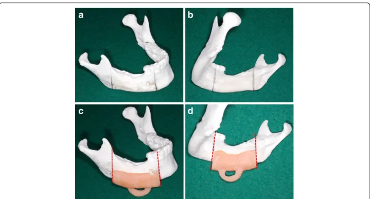 Fig. 2 Procedure for making the surgical device in case 1. a, b Based on the CT image, the range of segmental mandibular resection was marked on the 3D model