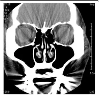 Fig. 4 Computed tomography (CT) view at 3.5 months follow-up.