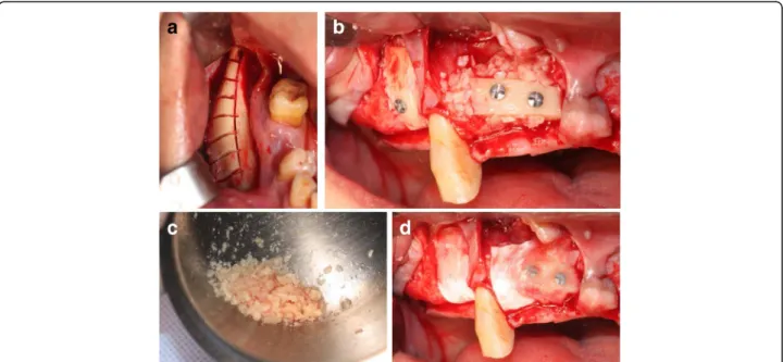 Fig. 1 Procedure of MBB graft. a Donor site after sawing mandibular body bone. b Fixed block bone by lag screw technique