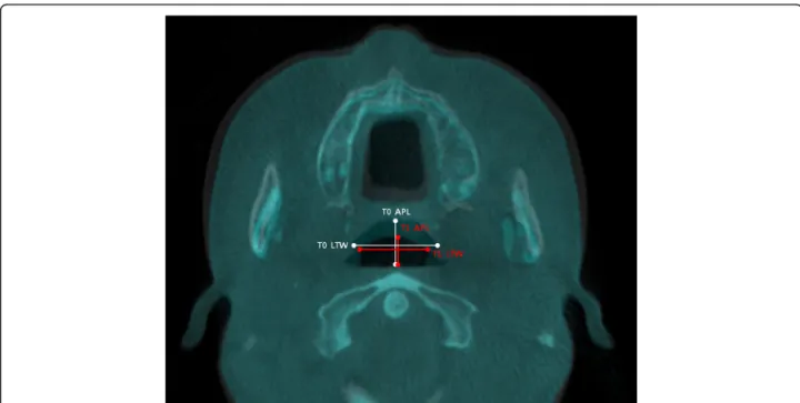Fig. 2 Evaluation of the pharyngeal airway changes. The largest transverse width ( LTW) and anteroposterior length (APL) on each axial plane (CV1, CV2, CV3) were measured at T0 and T1