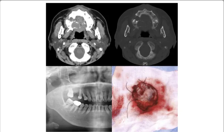 Fig. 1 Preoperative computerized tomographic (CT) scan (top) and panoramic radiograph (bottom left) showed a round mass on the right palatal area.
