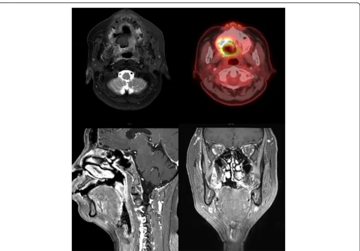 Fig. 2 Magnetic resonance imaging (top left and bottom) and whole-body positron emission tomography (top right) showed no unusual finding following operation and mildly increased FDG uptake on the right hard palate, likely postoperative changes