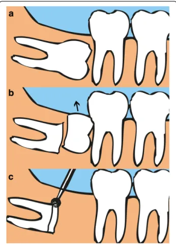 Fig. 1 Intentional partial odontectomy. a Pre-operative mandibular third molar. b Coronectomy of the molar at cementoenamel  junc-tion (c)